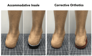 Corrective vs. Accommodative Insoles: Making the Right Choice