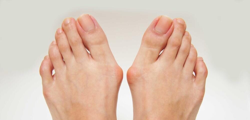 Orthotics for bunions on sale and flat feet